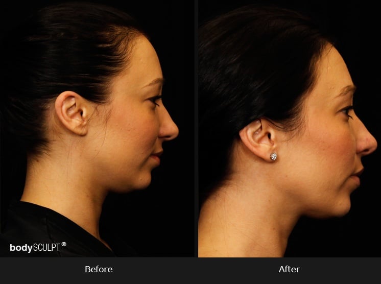 Kybella - Before & After Photos