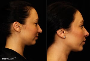 Kybella Before and After Photos