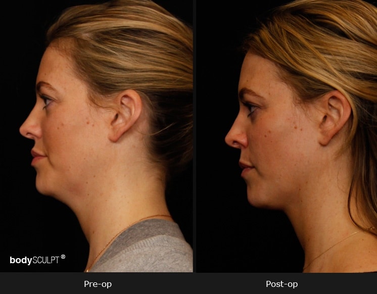 SmartLipo Neck Liposuction - Patient 1 Before & After Photos