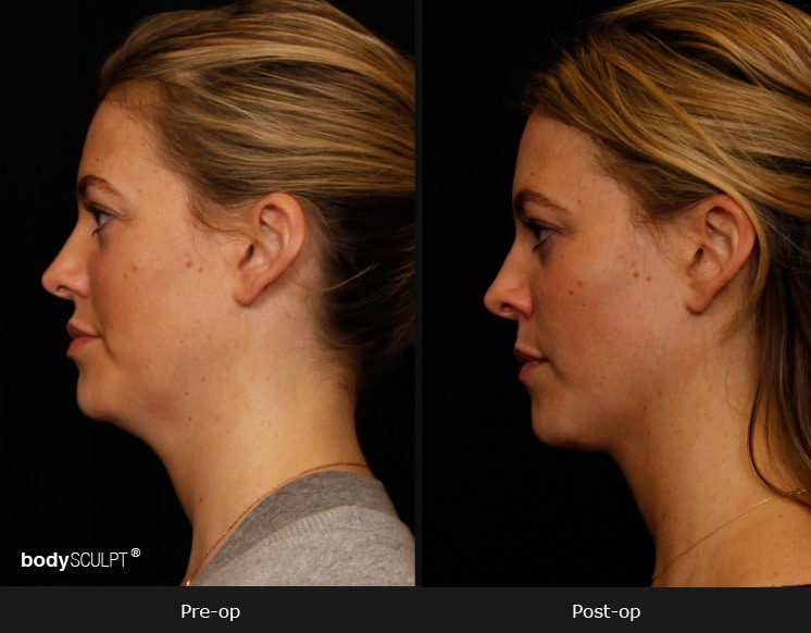 Neck Liposuction with Smartlipo Before & After Photos