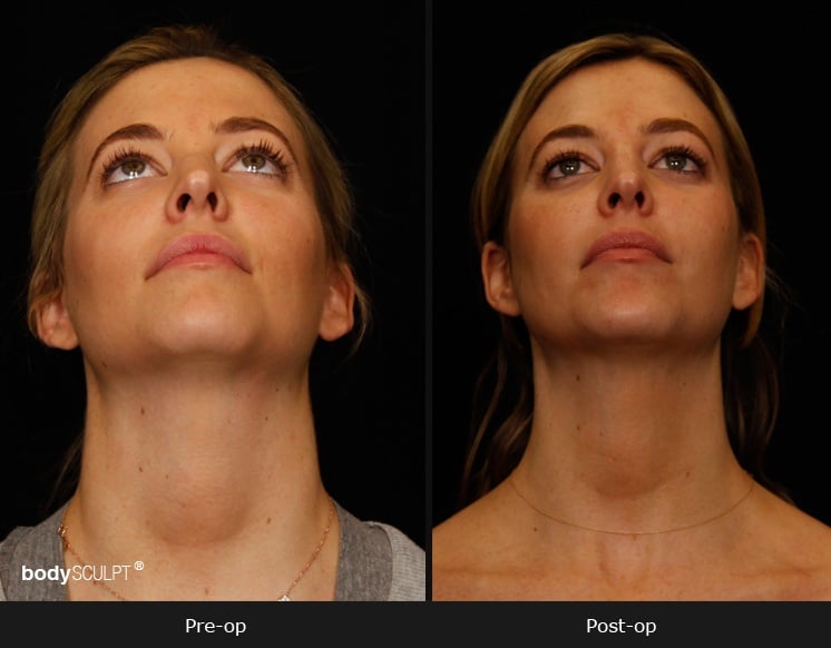 SmartLipo Neck Liposuction - Patient 1 Before & After Photos