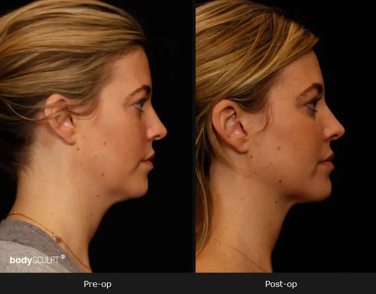 Smartlipo Neck Liposuction - Patient 1 Before & After Photos