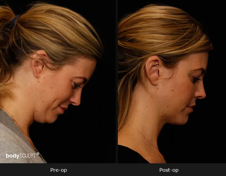 Smartlipo Neck Liposuction - Patient 1 Before & After Photos