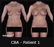 Composite Breast Augmentation - Patient 1