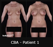 Composite Breast Augmentation - Before & After Photos