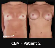 Composite Breast Augmentation - Before & After Photos