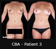 Composite Breast Augmentation - Before & After Photos