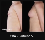 Composite Breast Augmentation - Before & After Photos