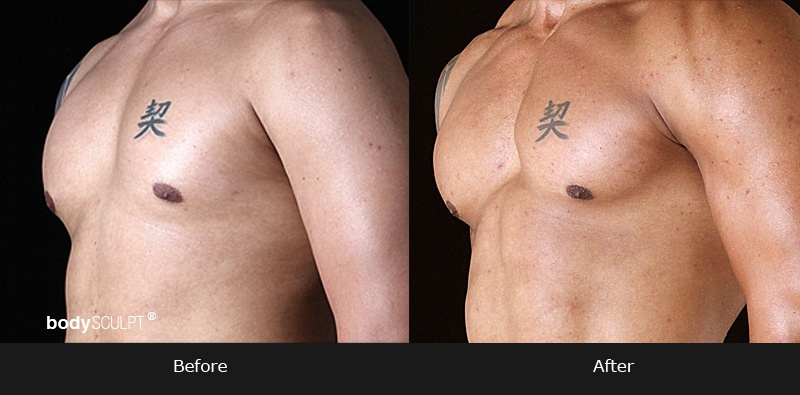 Pectoral Implants - Before & After Photos