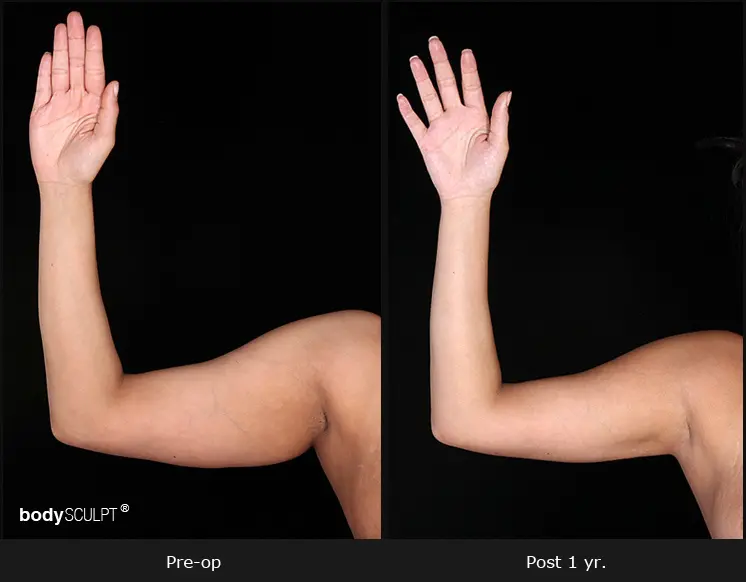 Scarless Female Arm Lift Before After Photos