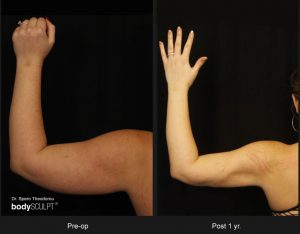 Scarless Female Arm Lift