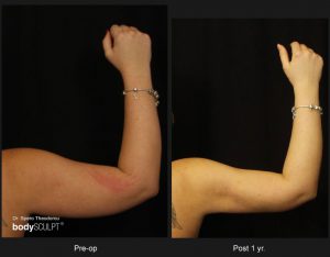 Scarless Female Arm Lift