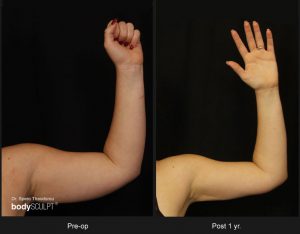 Scarless Female Arm Lift