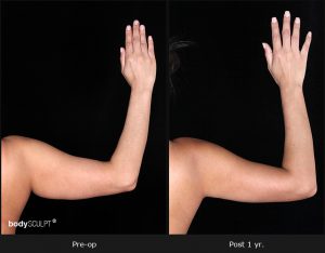 Scarless Female Arm Lift