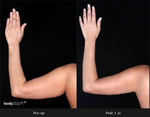 Scarless Female Arm Lift