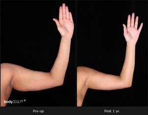 Scarless Female Arm Lift