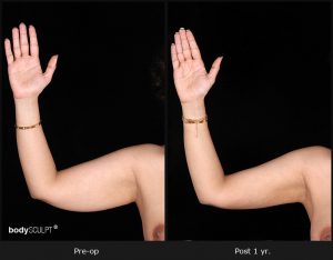 Scarless Female Arm Lift