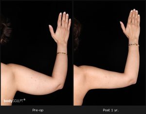 Scarless Female Arm Lift