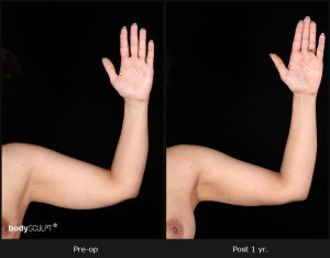 Scarless Female Arm Lift