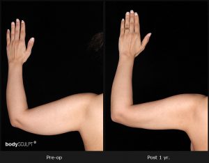 Scarless Female Arm Lift