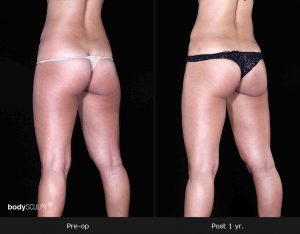 Leg and Thighs Liposuction - Before & After Photos