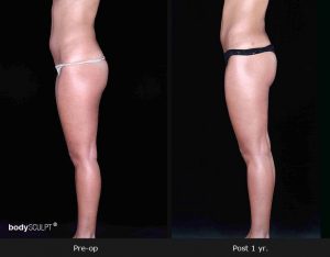 Leg and Thighs Liposuction - Before & After Photos