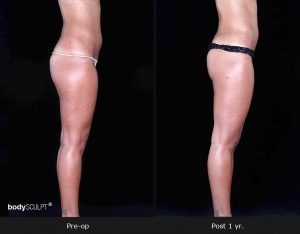 Leg and Thighs Liposuction - Before & After Photos