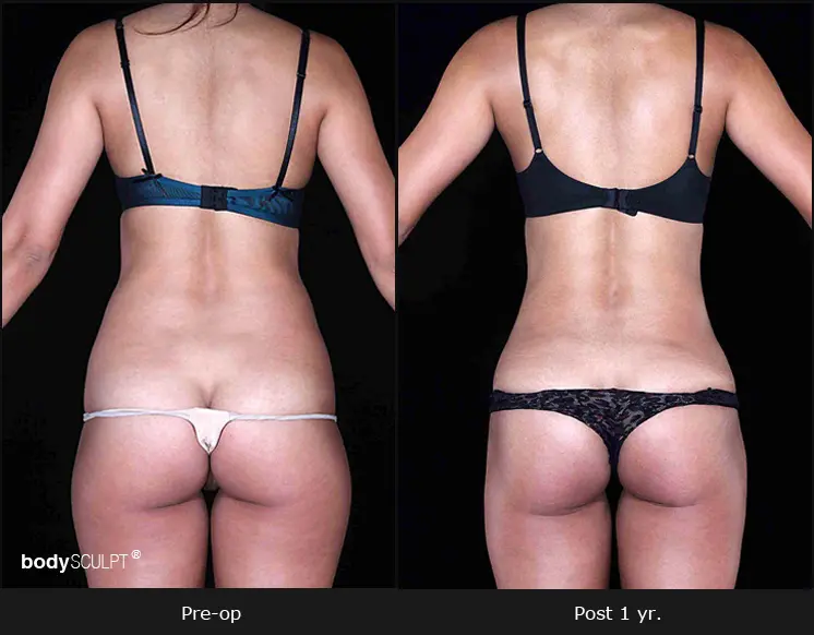 Smartlipo Flanks Liposuction for Women - Before & After Photos