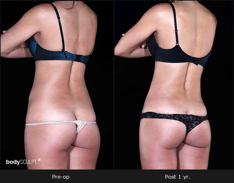 Smartlipo Flanks Liposuction for Women - Before & After Photos