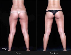 Leg and Thighs Liposuction - Before & After Photos