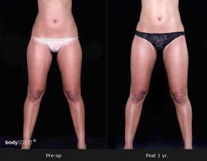 Leg and Thighs Liposuction - Before & After Photos