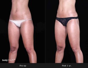 Leg and Thighs Liposuction - Before & After Photos