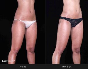 Leg and Thighs Liposuction - Before & After Photos