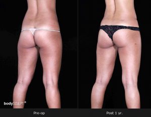 Leg and Thighs Liposuction - Before & After Photos