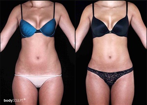 SmartLipo Triplex Liposuction - Before and After Photos