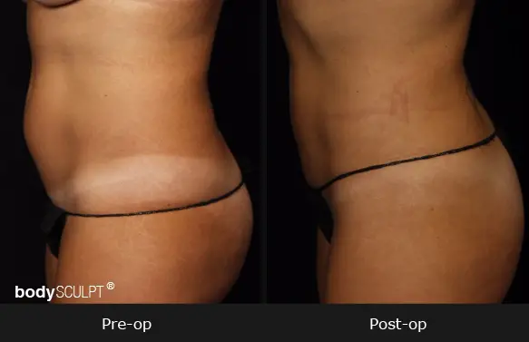Smartlipo Flanks Liposuction for Women - Before & After Photos