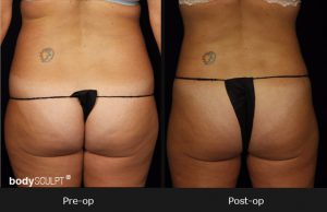 Smartlipo Abdomen - Before & After Photos