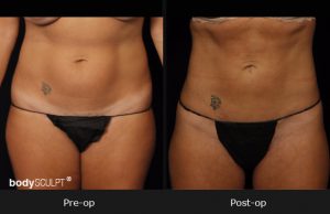 Smartlipo Abdomen - Before & After Photos