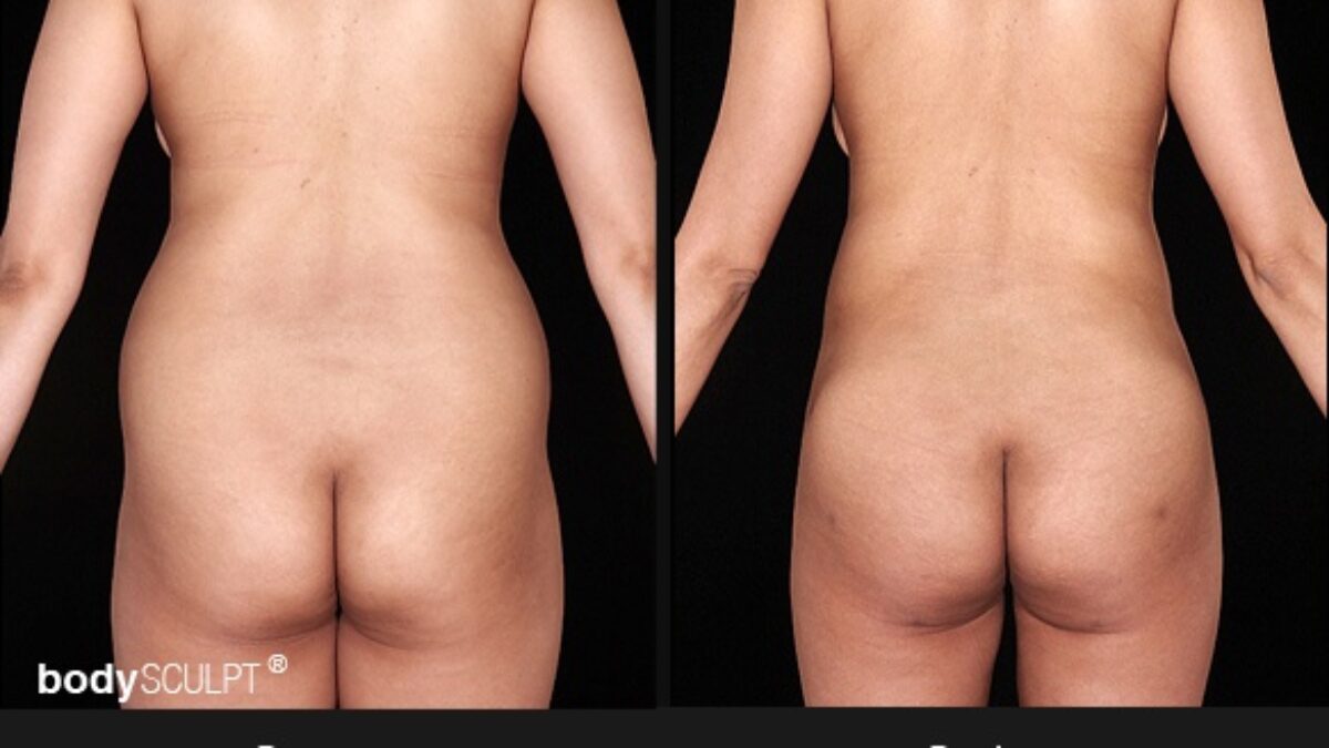 Smartlipo Flanks Liposuction for Women - Before & After Photos