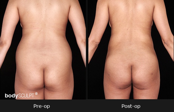 Flanks Liposuction  Before and After Photos - Palm Clinic