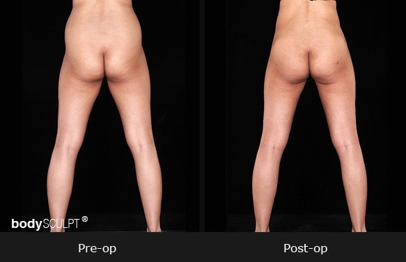 Smartlipo Flanks Liposuction for Women - Before & After Photos