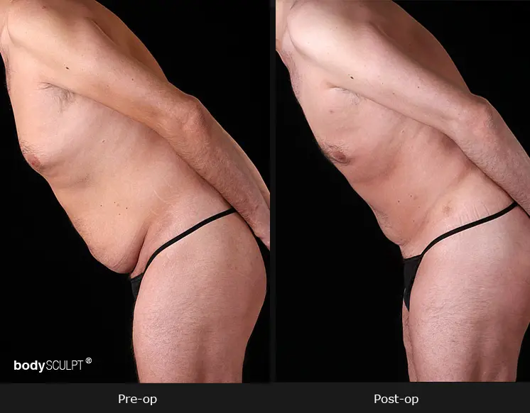 Male Tummy Tuck - Before & After Photos