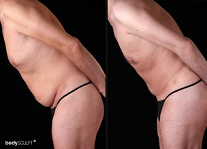 Male Tummy Tuck - Before and After Photos