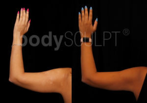 Scarless Arm Lift