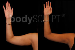 Scarless Arm Lift