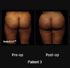 Brazilian Butt Lift