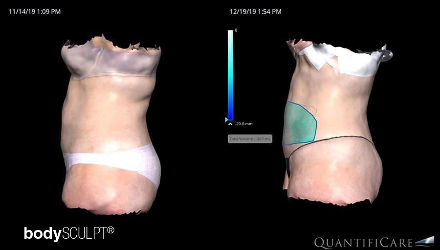 two-year postoperative view of the patient (wearing underwear) showing