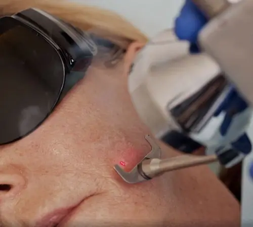 Sciton Joule Er:YAG Laser