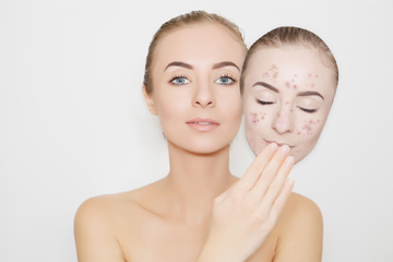 6 Natural Ways To Get Rid Of Blackheads
