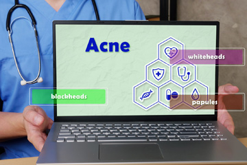 Effective Medical and Home Remedies to Reduce Acne Scars